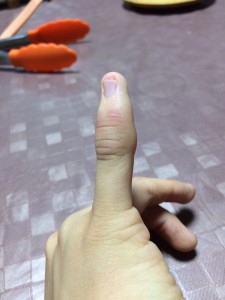 指の捻挫による炎症