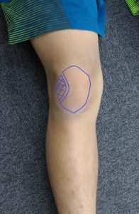 有痛性分離膝蓋骨（Ⅱ型）